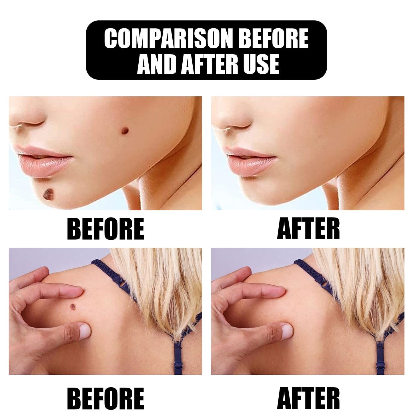 Mole Wart Serum Organic Tags Solutions No Trace Painle Skin Remover Removal Cream Painless Face Freckle Beauty 0 DailyAlertDeals