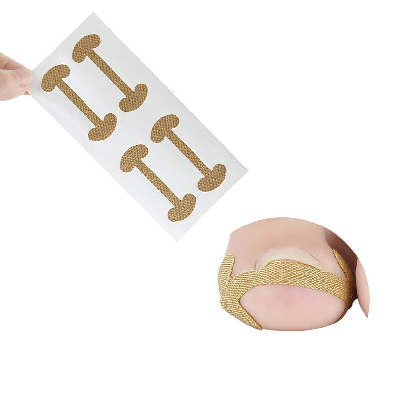 Ingrown Toenail Corrector Sticker Nail Strip Anti-roll Nail Free Glue Toe Inlay Nail Corrector Patch Correction Stickers Toenail foot nail care tool DailyAlertDeals   