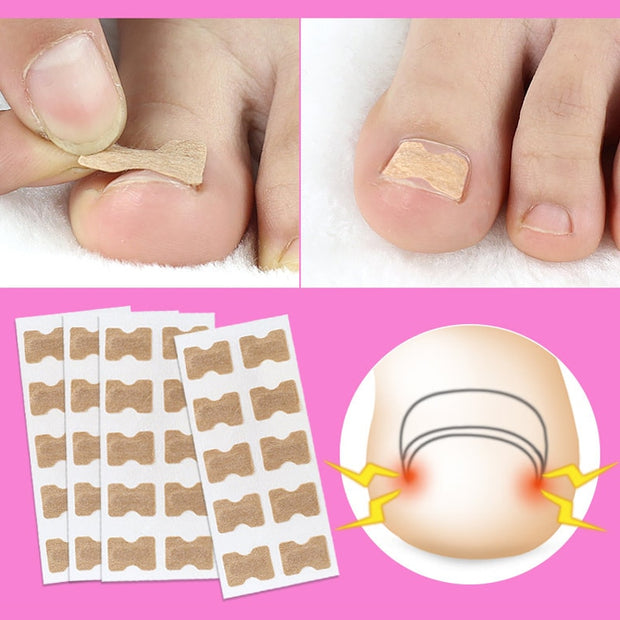 Ingrown Toenail Corrector Sticker Nail Strip Anti-roll Nail Free Glue Toe Inlay Nail Corrector Patch Correction Stickers Toenail foot nail care tool DailyAlertDeals   