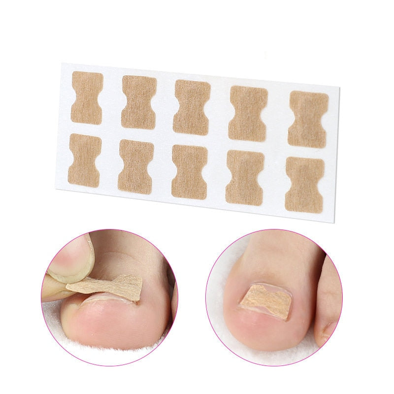 Ingrown Toenail Corrector Sticker Nail Strip Anti-roll Nail Free Glue Toe Inlay Nail Corrector Patch Correction Stickers Toenail foot nail care tool DailyAlertDeals 10Pcs Type B  