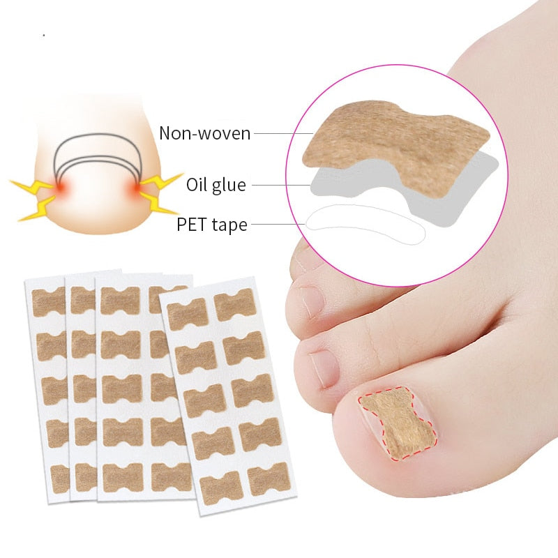 Ingrown Toenail Corrector Sticker Nail Strip Anti-roll Nail Free Glue Toe Inlay Nail Corrector Patch Correction Stickers Toenail foot nail care tool DailyAlertDeals   