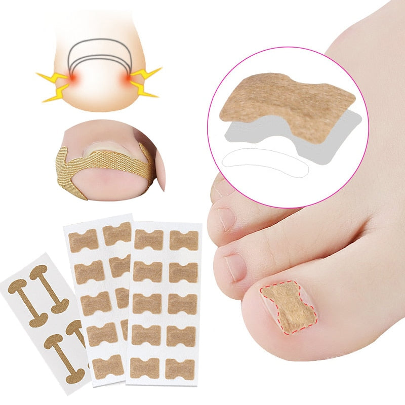 Ingrown Toenail Corrector Sticker Nail Strip Anti-roll Nail Free Glue Toe Inlay Nail Corrector Patch Correction Stickers Toenail foot nail care tool DailyAlertDeals   