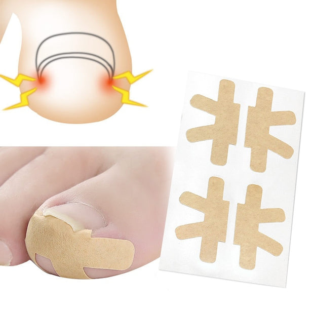 Ingrown Toenail Corrector Sticker Nail Strip Anti-roll Nail Free Glue Toe Inlay Nail Corrector Patch Correction Stickers Toenail foot nail care tool DailyAlertDeals 4PCS G200  