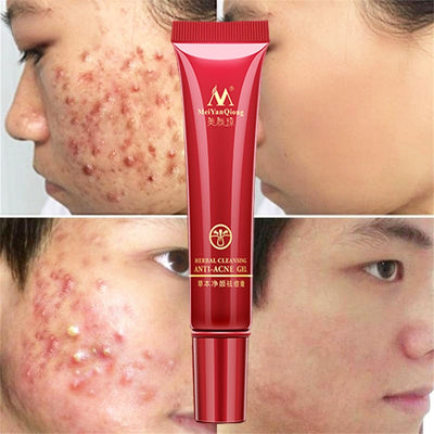 Effective Acne Removal Cream Herbal Anti-acne Repair Fade Acne Spots Health & Beauty hozanas4life   