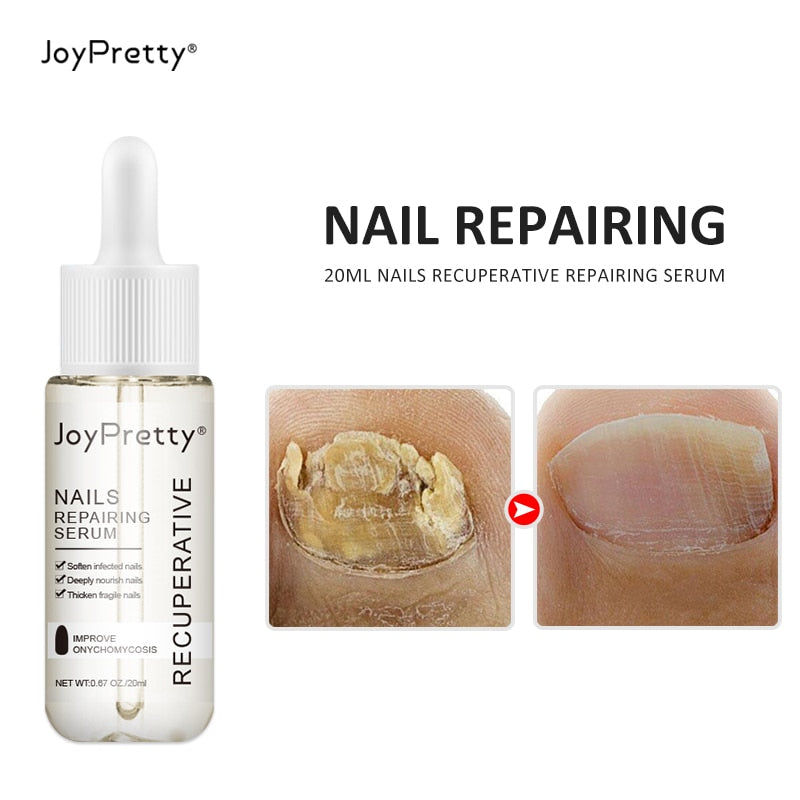 JoyPretty Foot Nail Fungus Treatment Serum Anti Fungi Feet Care Against Fungal  hozanas4life   