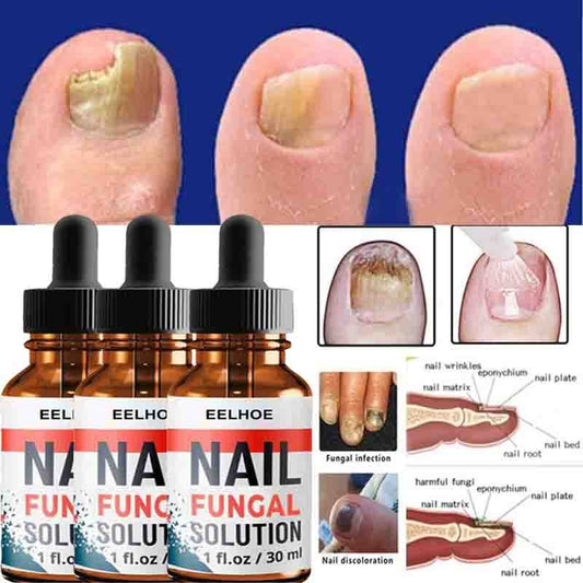 Nail Repair Serum Nail Fungal Treatment Serum  hozanas4life   
