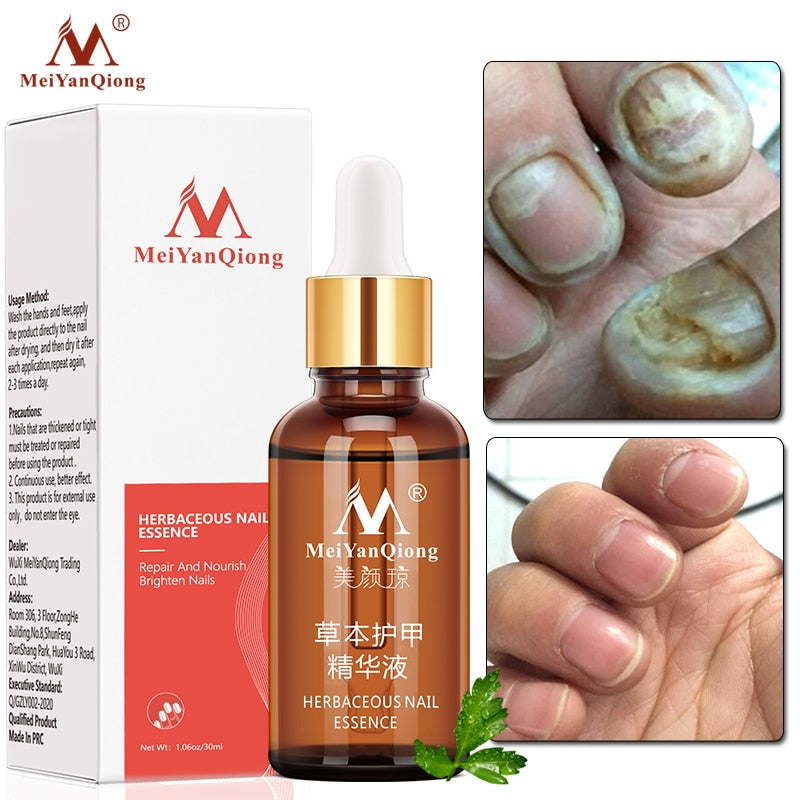 Nail Fungal Treatment Feet Care Essence Nail Foot Whitening  hozanas4life   